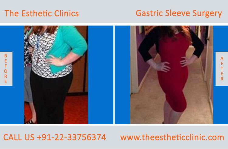 Gastric Sleeve Surgery, bariatric surgery before after photos in mumbai india (5)